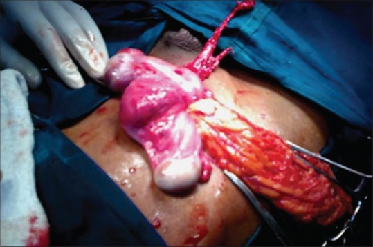 Persistent Mullerian Duct Syndrome with Transverse Testicular Ectopia.