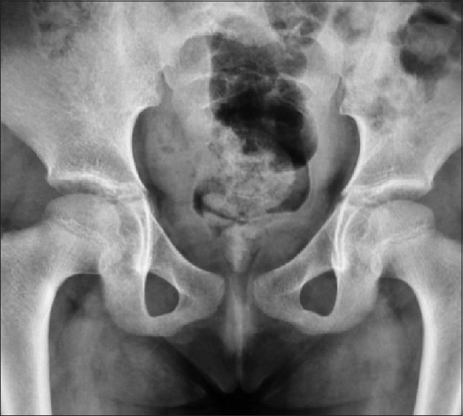 Female Urethral Anomalies in Pediatric Age Group: Uncovered.