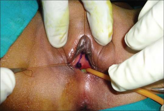 Female Urethral Anomalies in Pediatric Age Group: Uncovered.