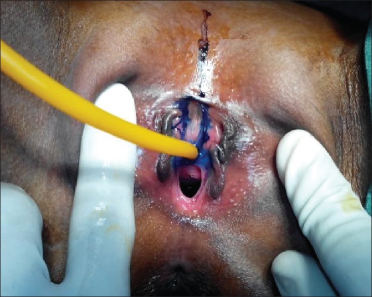 Female Urethral Anomalies in Pediatric Age Group: Uncovered.