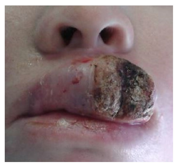 Oculocutaneous Albinism and Squamous Cell Carcinoma of the Skin of the Head and Neck in Sub-Saharan Africa.