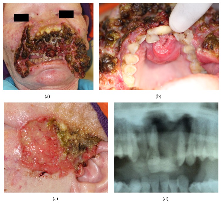 Oculocutaneous Albinism and Squamous Cell Carcinoma of the Skin of the Head and Neck in Sub-Saharan Africa.