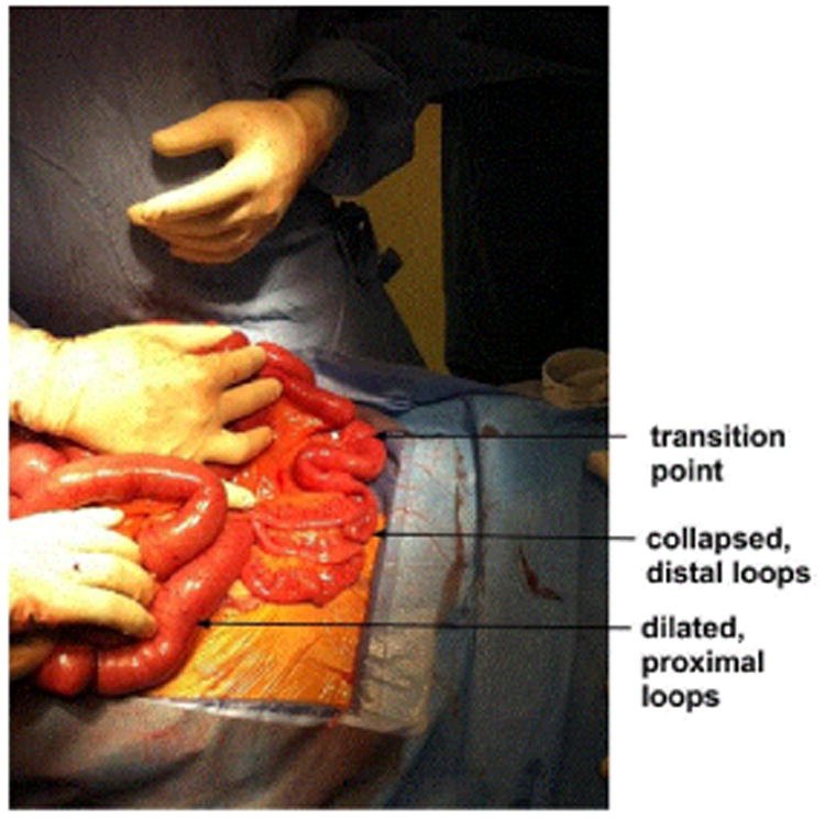 PhytobezoarInduced Small Bowel Obstruction in a Young Male with Virgin Abdomen.