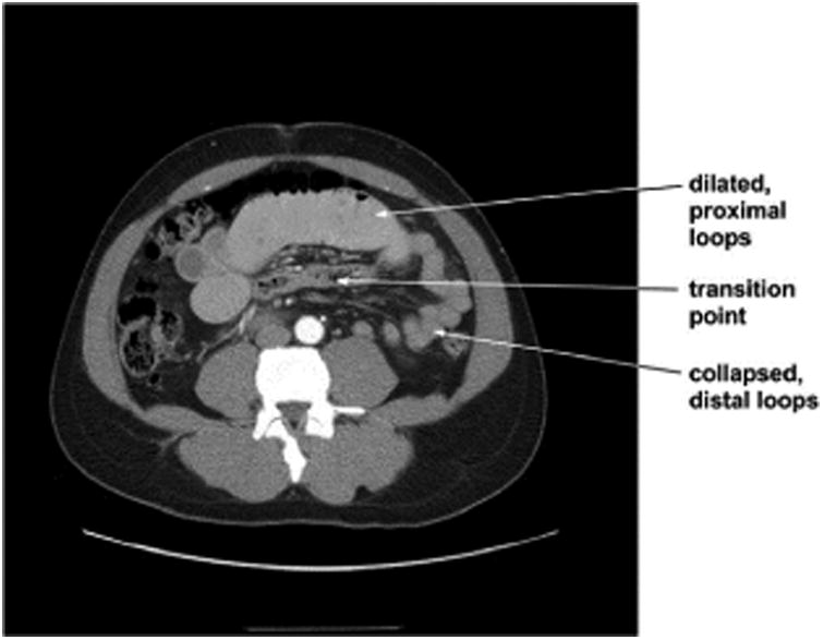 PhytobezoarInduced Small Bowel Obstruction in a Young Male with Virgin Abdomen.