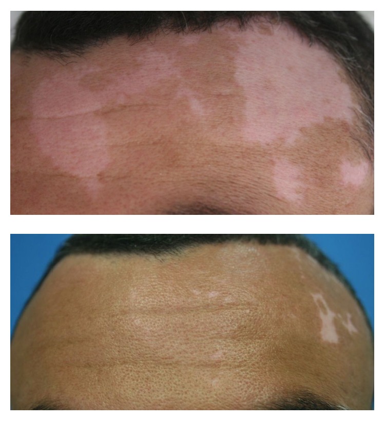 Immunological Parameters Associated With Vitiligo Treatments: A Literature Review Based on Clinical Studies.