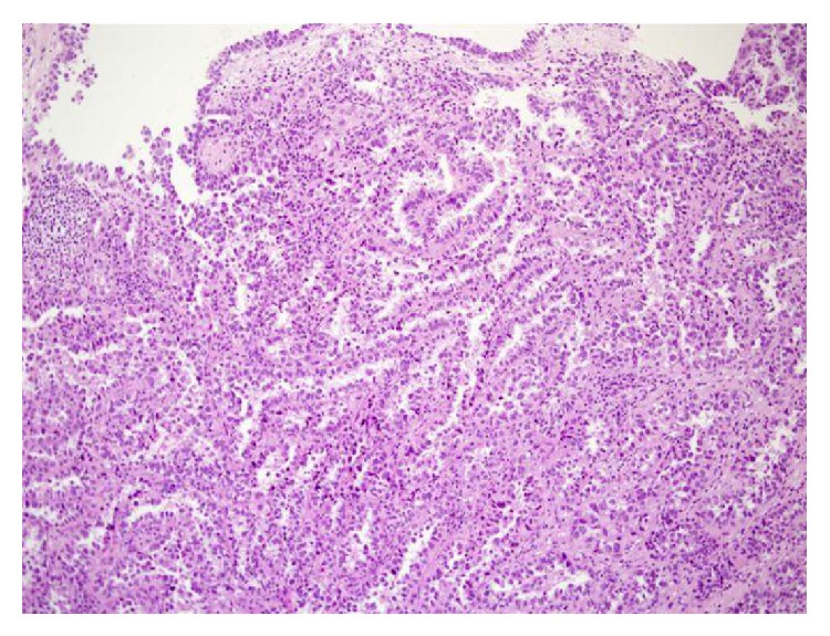 Clear cell adenocarcinoma of the urethra: review of the literature.