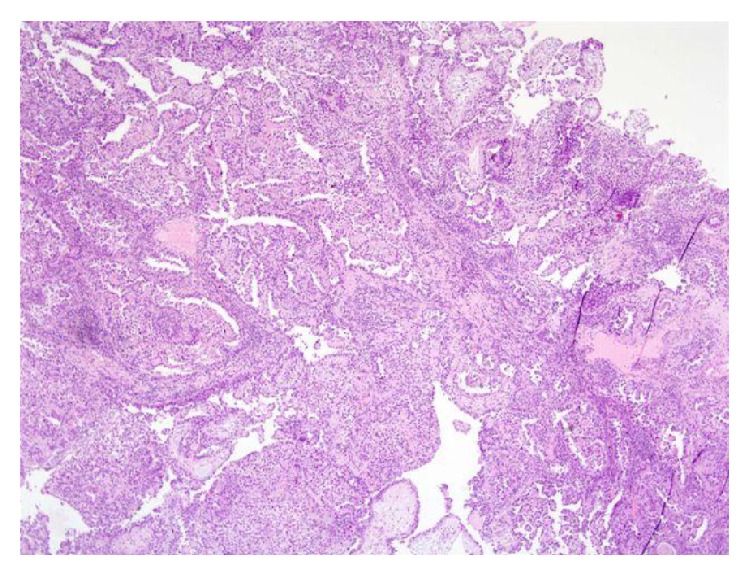 Clear cell adenocarcinoma of the urethra: review of the literature.