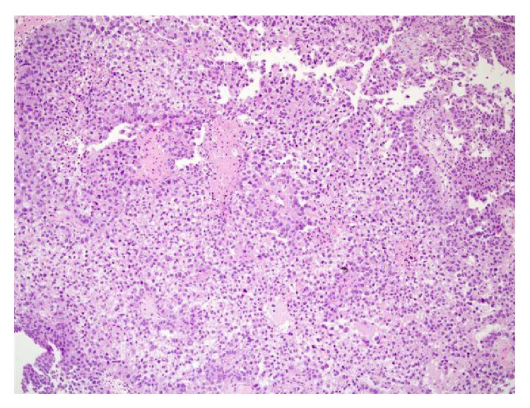 Clear cell adenocarcinoma of the urethra: review of the literature.