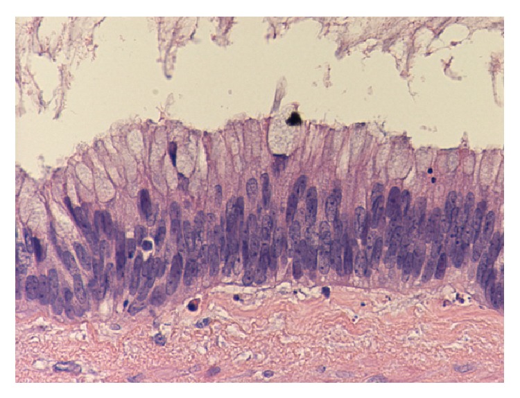 Mucus containing cystic lesions "mucocele" of the appendix: the unresolved issues.