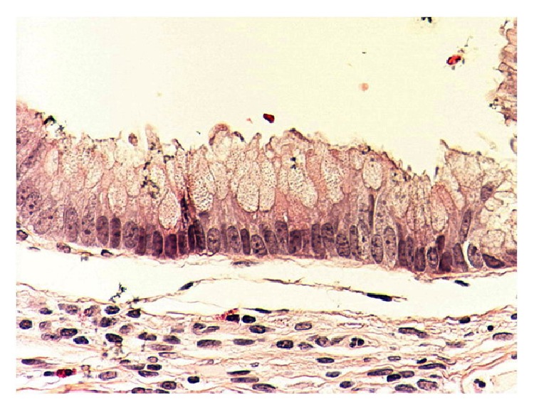 Mucus containing cystic lesions "mucocele" of the appendix: the unresolved issues.