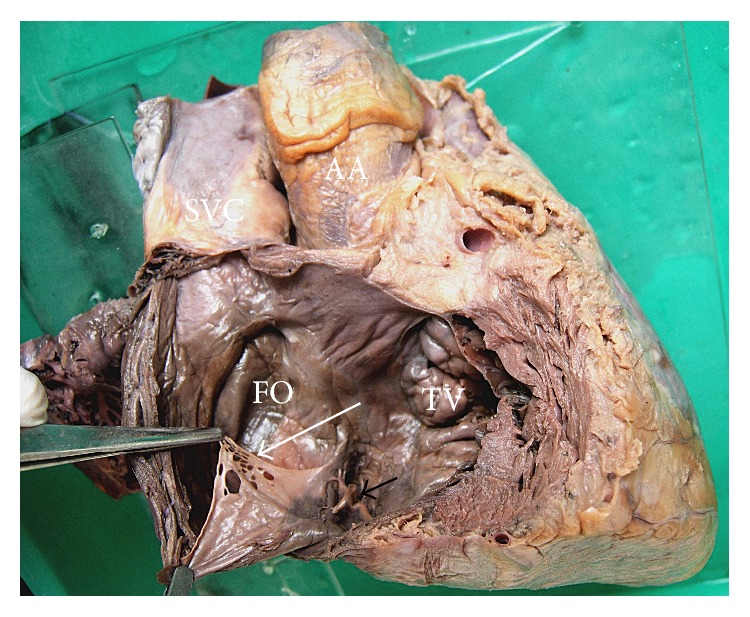 Anatomical Study of Chiari Network and the Remnant of Left Venous Valve in the Interior of Right Atrium.