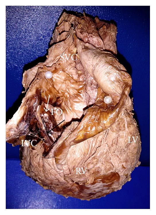 Anatomical Study of Chiari Network and the Remnant of Left Venous Valve in the Interior of Right Atrium.