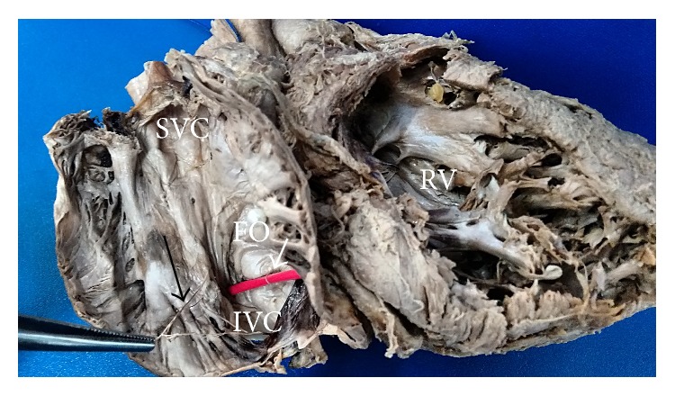 Anatomical Study of Chiari Network and the Remnant of Left Venous Valve in the Interior of Right Atrium.