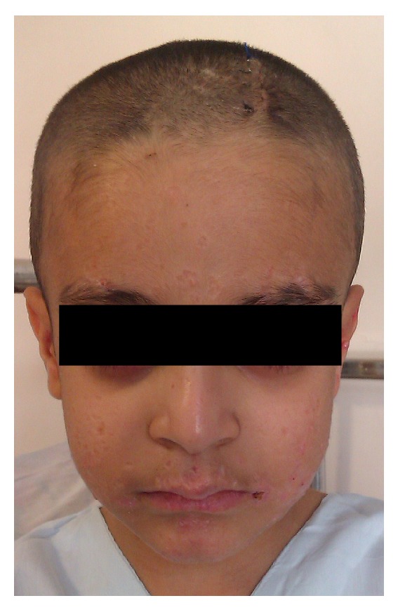 Brain Abscess and Keratoacanthoma Suggestive of Hyper IgE Syndrome.