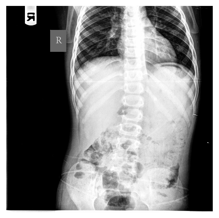 Brain Abscess and Keratoacanthoma Suggestive of Hyper IgE Syndrome.