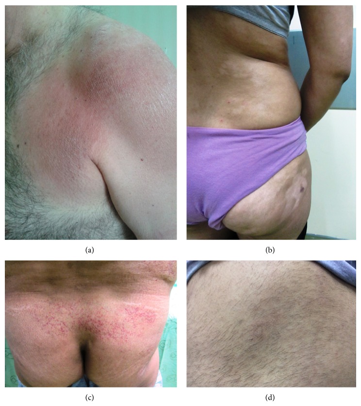 Mycosis fungoides in Iranian population: an epidemiological and clinicopathological study.