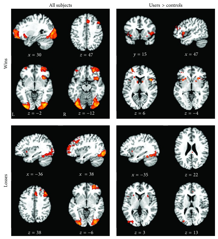 Functional activation and effective connectivity differences in adolescent marijuana users performing a simulated gambling task.