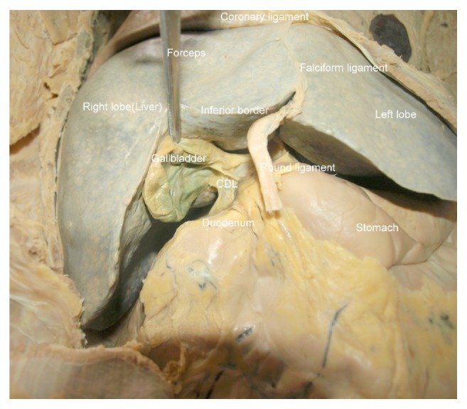 The Prevalence and Classification of the Cystoduodenal Ligament.