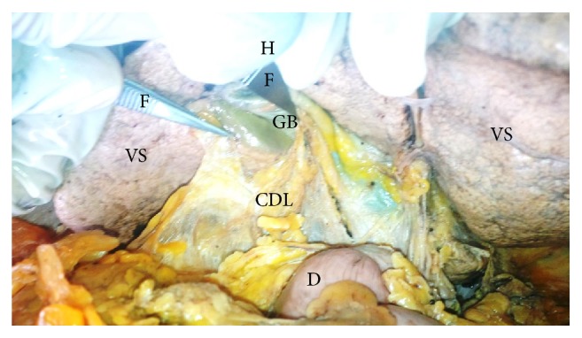 The Prevalence and Classification of the Cystoduodenal Ligament.