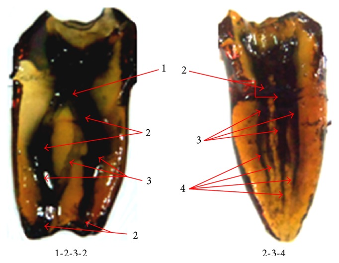 Variations in the Root Form and Root Canal Morphology of Permanent Mandibular First Molars in a Sri Lankan Population.