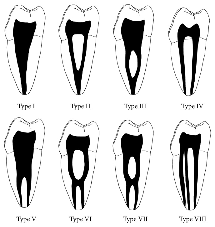 Variations in the Root Form and Root Canal Morphology of Permanent Mandibular First Molars in a Sri Lankan Population.