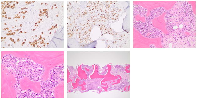 Stabilization of bone marrow infiltration by metastatic breast cancer with continuous doxorubicin