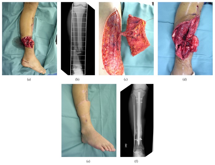 Free flap transfer to preserve main arterial flow in early reconstruction of open fracture in the lower extremity.