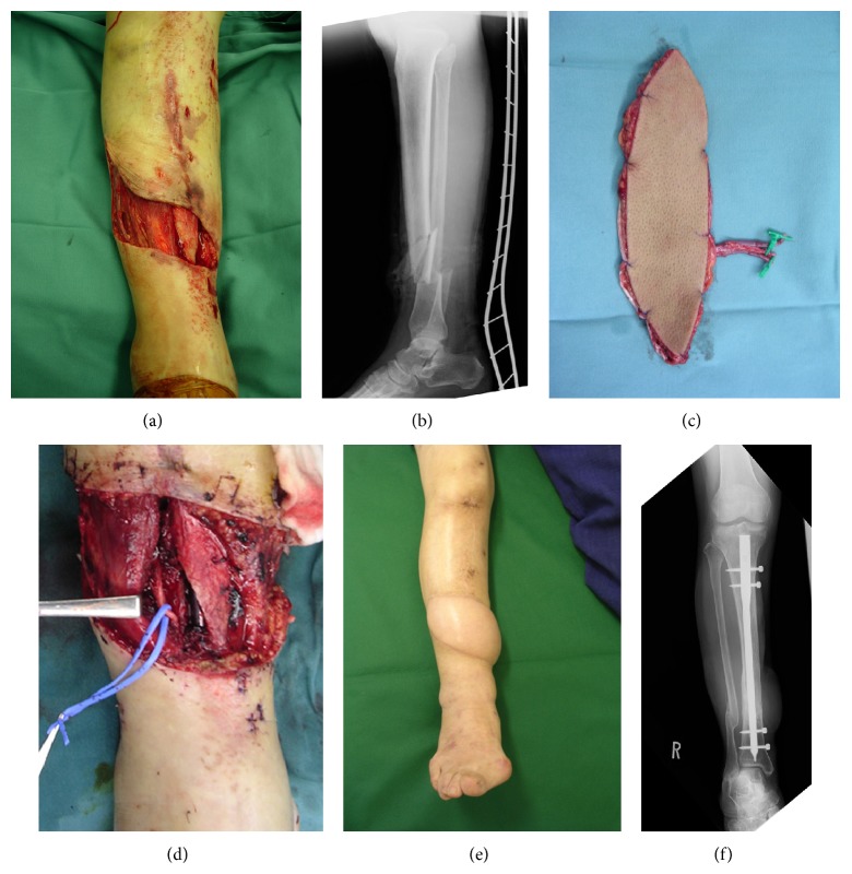 Free flap transfer to preserve main arterial flow in early reconstruction of open fracture in the lower extremity.