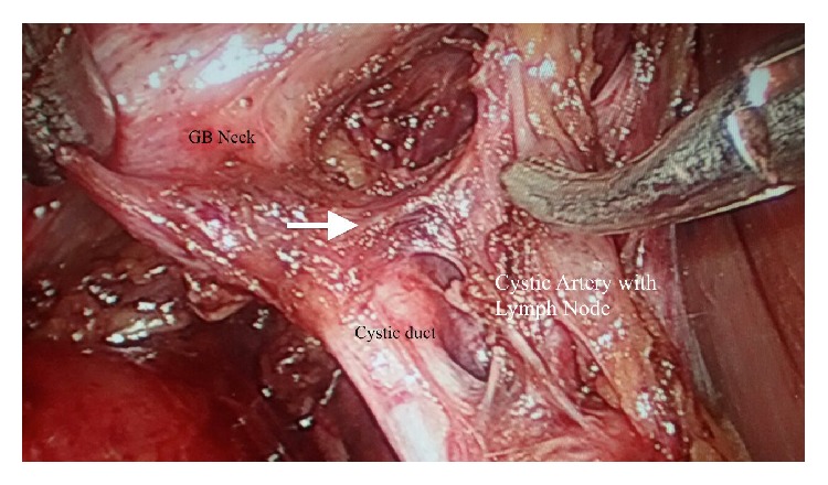 Artery to Cystic Duct: A Consistent Branch of Cystic Artery Seen in Laparoscopic Cholecystectomy.