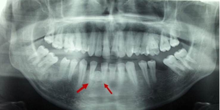 Peripheral osteoma of the mandible: a case report.