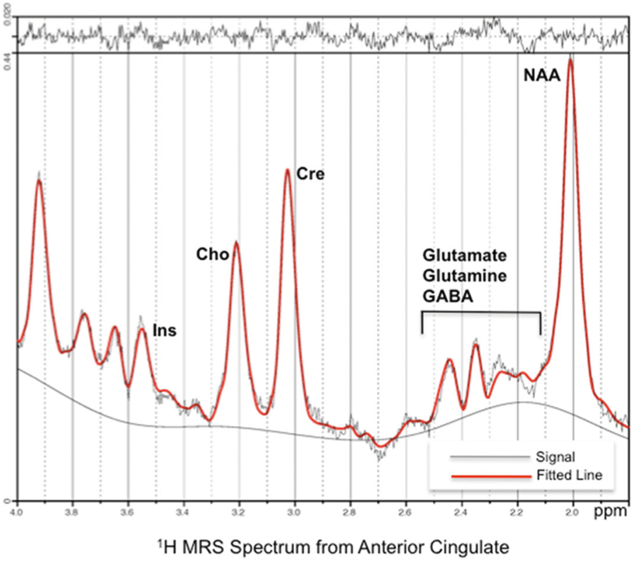 <sup>1</sup>H-MRS glutamate level predicts auditory sensory gating in alcohol dependence: Preliminary results.