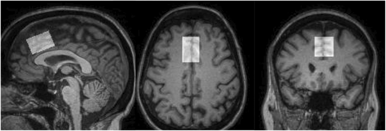 <sup>1</sup>H-MRS glutamate level predicts auditory sensory gating in alcohol dependence: Preliminary results.