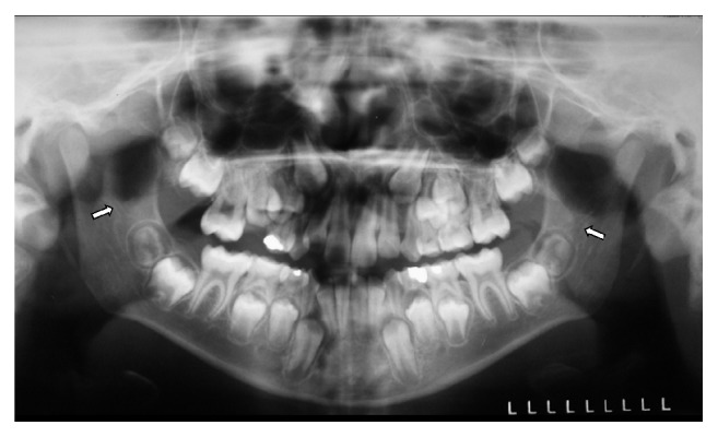 Retromolar Canal Associated with Age, Side, Sex, Bifid Mandibular Canal, and Accessory Mental Foramen in Panoramic Radiographs of Brazilians.