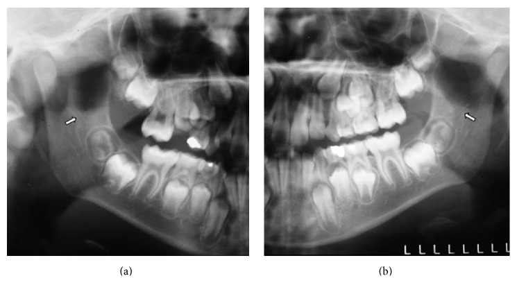 Retromolar Canal Associated with Age, Side, Sex, Bifid Mandibular Canal, and Accessory Mental Foramen in Panoramic Radiographs of Brazilians.