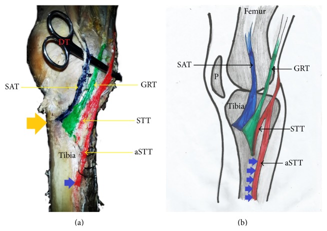 Pes Anserinus Structural Framework and Constituting Tendons Are Grossly Aberrant in Nigerian Population.