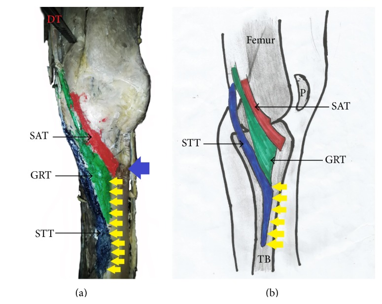Pes Anserinus Structural Framework and Constituting Tendons Are Grossly Aberrant in Nigerian Population.