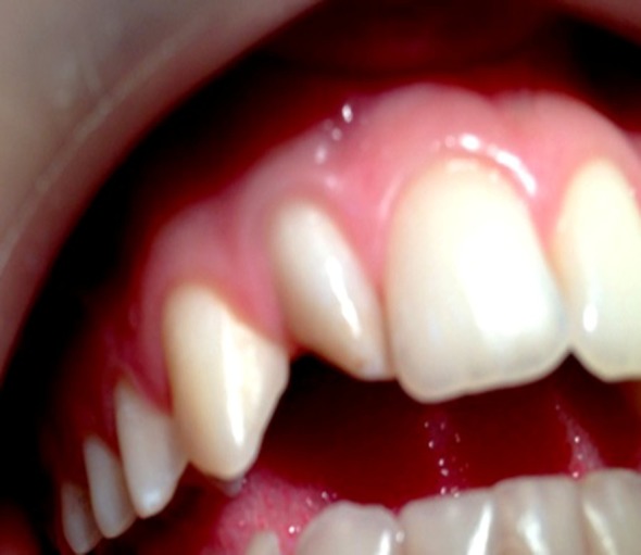 Management of dens invaginatus type II with periapical lesion: case report.