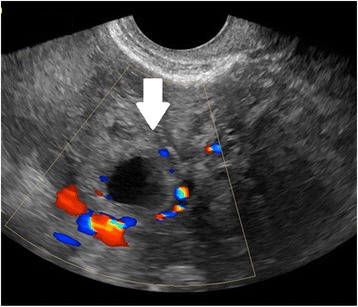 Incidence, diagnosis and management of tubal and nontubal ectopic pregnancies: a review.