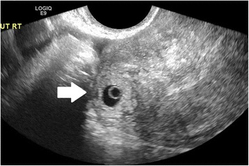 Incidence, diagnosis and management of tubal and nontubal ectopic pregnancies: a review.