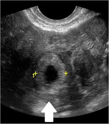 Incidence, diagnosis and management of tubal and nontubal ectopic pregnancies: a review.