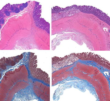 Safety and efficacy of a side-to-side duodeno-ileal anastomosis for weight loss and type-2 diabetes: duodenal bipartition, a novel metabolic surgery procedure.