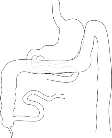 Safety and efficacy of a side-to-side duodeno-ileal anastomosis for weight loss and type-2 diabetes: duodenal bipartition, a novel metabolic surgery procedure.