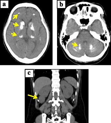 A novel loss-of-function mutation of GATA3 (p.R299Q) in a Japanese family with Hypoparathyroidism, Deafness, and Renal Dysplasia (HDR) syndrome.