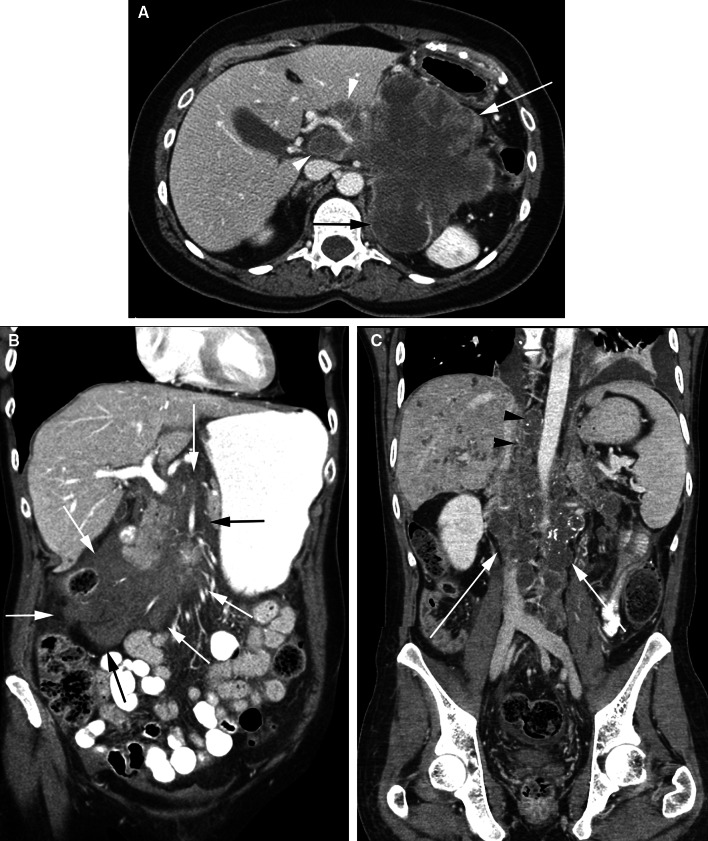 The subperitoneal space and peritoneal cavity: basic concepts.