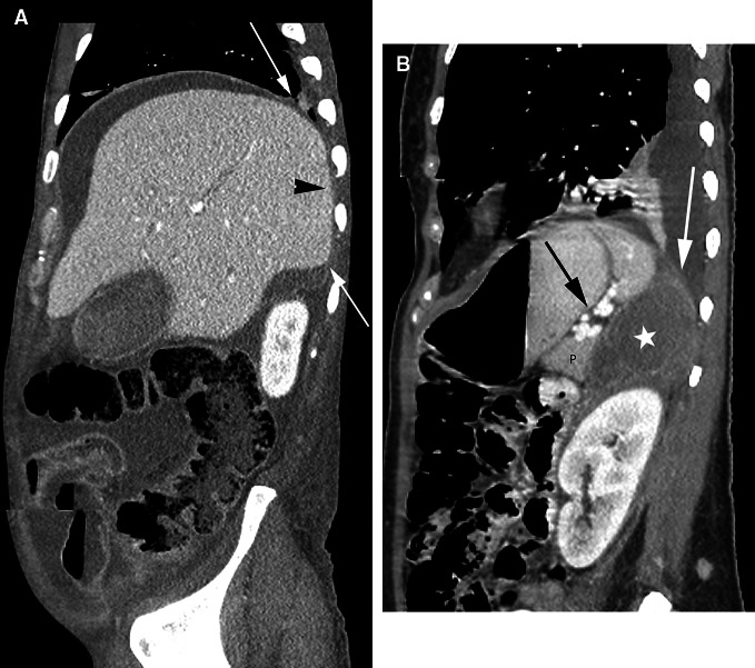 The subperitoneal space and peritoneal cavity: basic concepts.