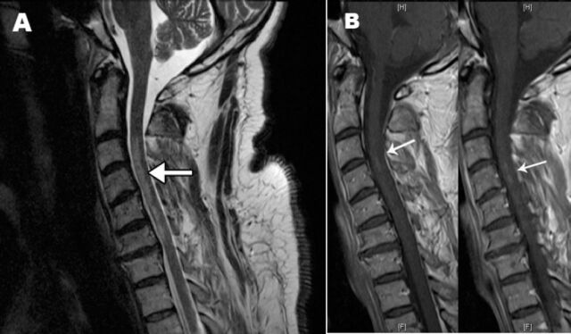 Acute cervical cord infarction in anterior spinal artery territory with acute swelling mimicking myelitis.
