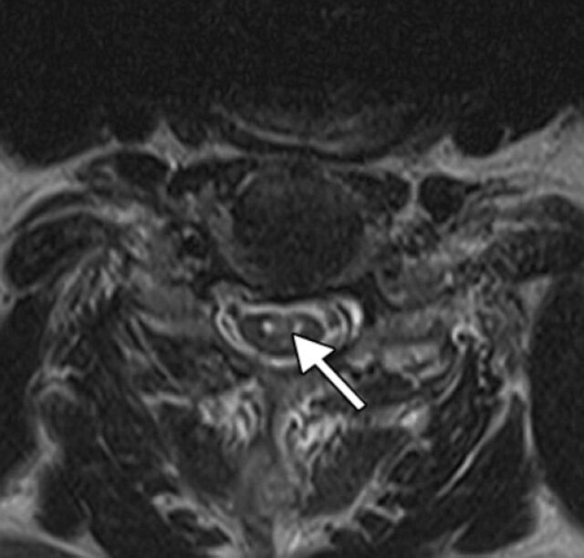 Acute cervical cord infarction in anterior spinal artery territory with acute swelling mimicking myelitis.