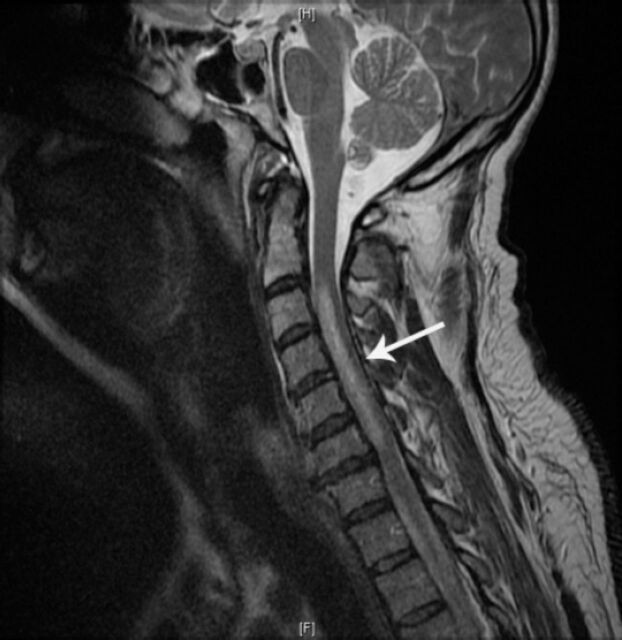Acute cervical cord infarction in anterior spinal artery territory with acute swelling mimicking myelitis.