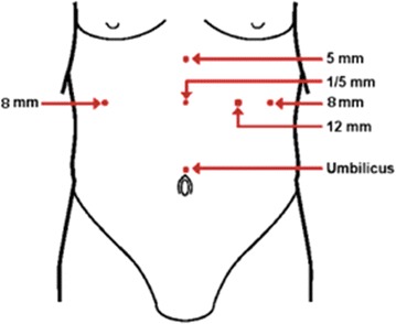 Most common robotic bariatric procedures: review and technical aspects.