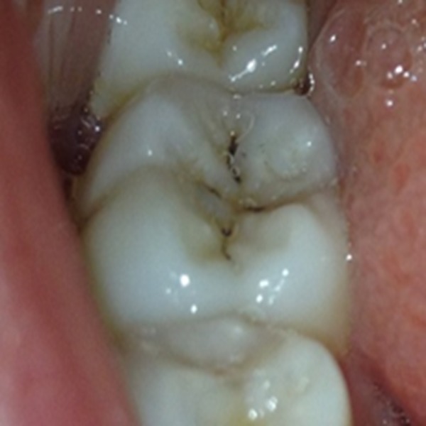 Icdas II criteria (international caries detection and assessment system).